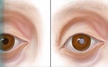 ต้อกระจก (Cataract)